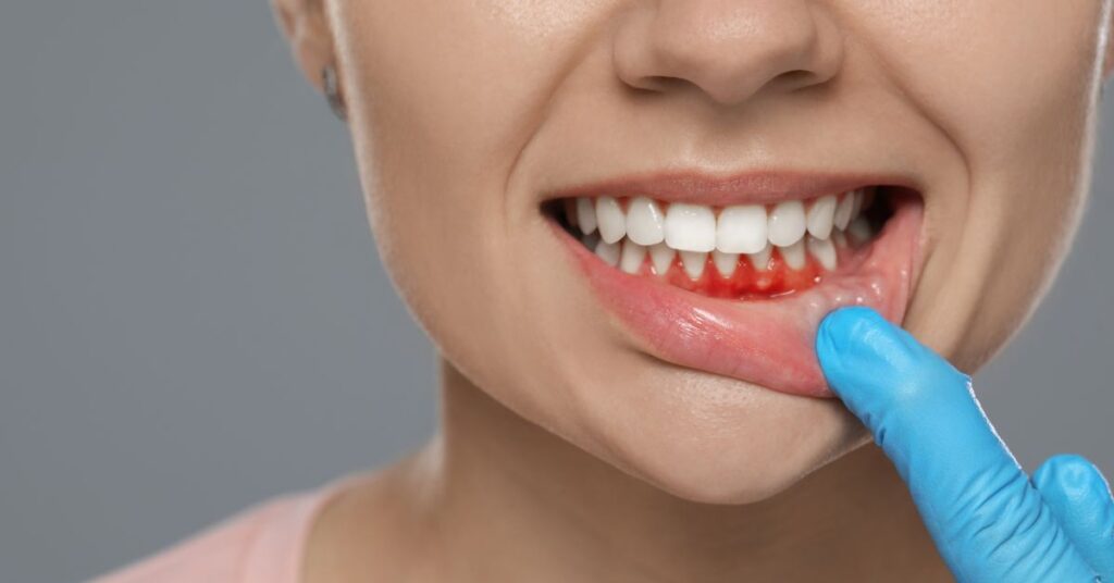Tooth Decay
