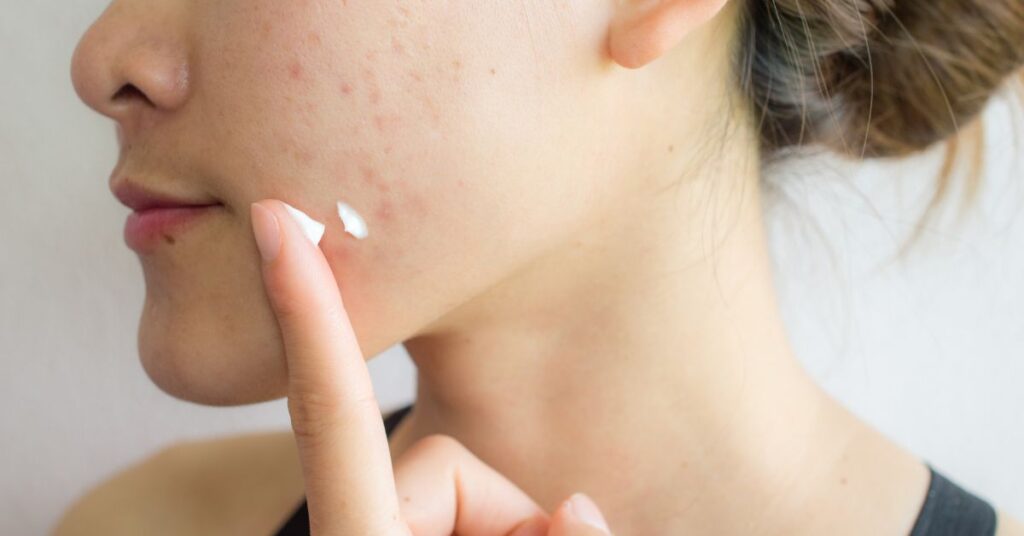acne solutions