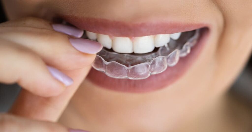 Clear Aligners
